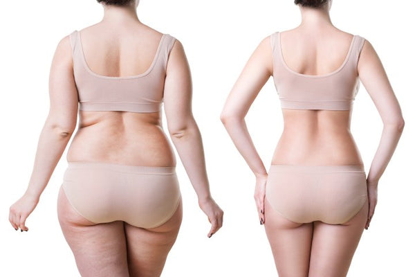 Abdomino lipo glúteos